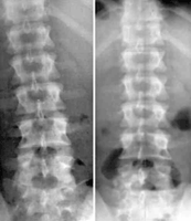 Pre and Post X-rays of corrected spine