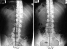 X-rays of misaligned body pre/post